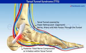 tarsal tunnel syndrome